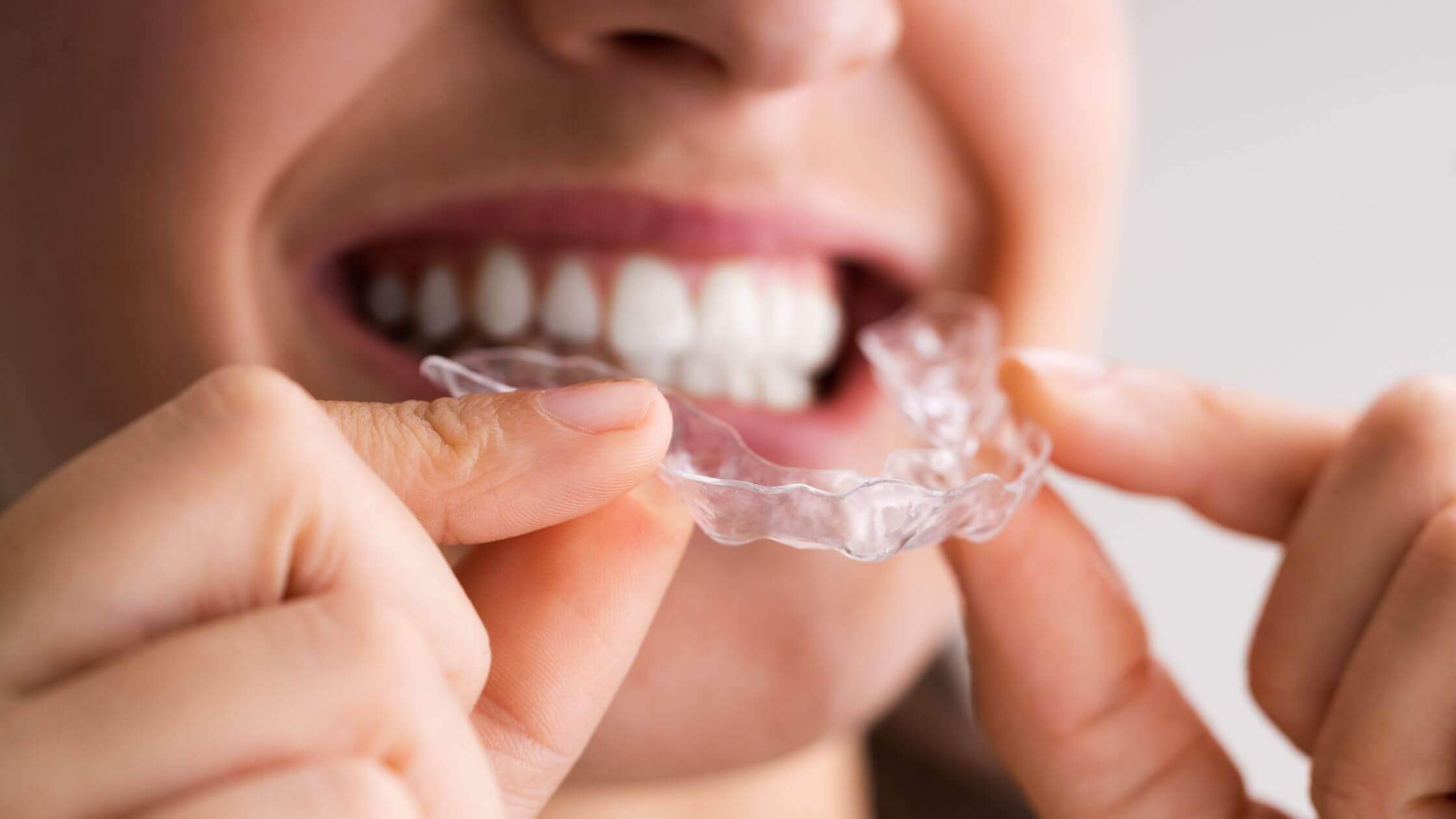 Some Questions that You Need to Ask Before Starting Your Clear Aligner Treatment