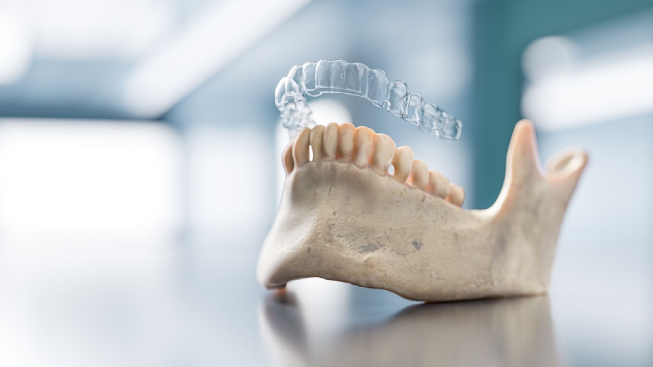 Are Aligners better than braces? Know your options