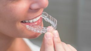 What Makes ClearPath Aligners Superior Over Other Aligner Brands in Pakistan