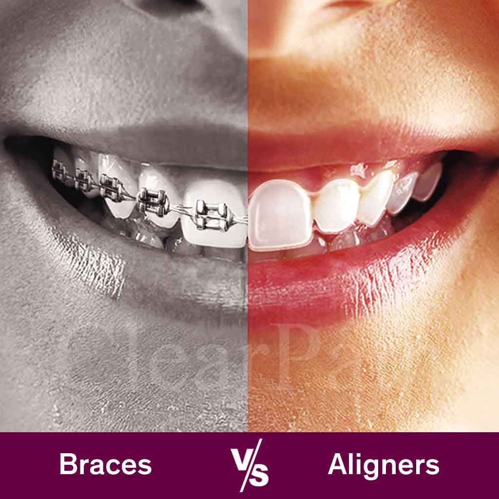 Aligners vs Braces: How they compare