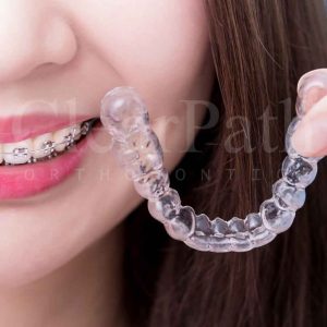 Clear Aligners shown upfront (with metal braces contrasted in the background)