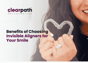 Aligners for Your Smile