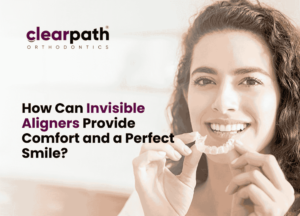 Invisible Aligners