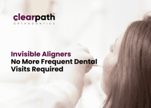 Invisible Aligners - No More Frequent Dental Visits Required
