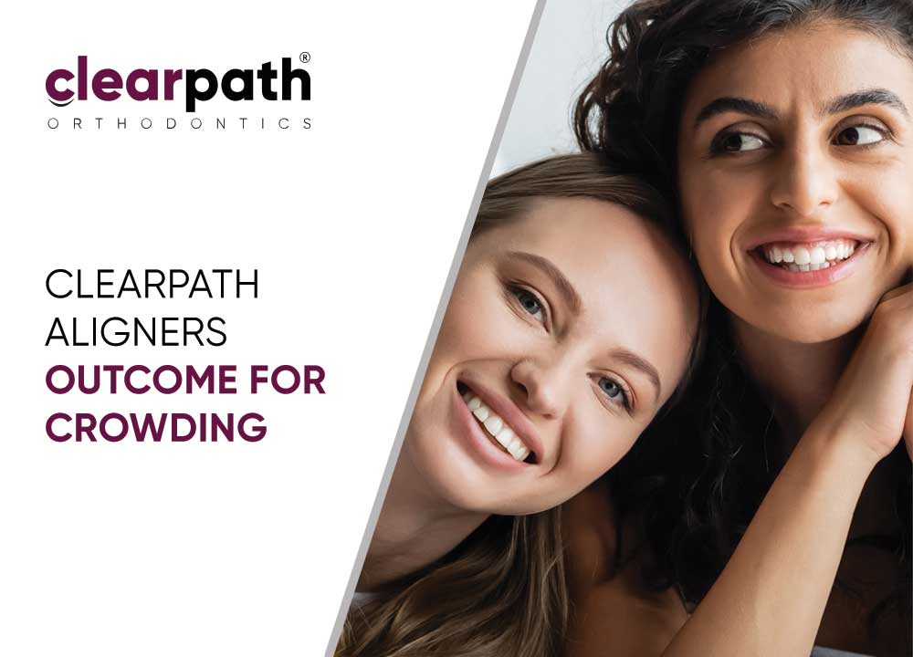Clearpath Aligners in Resolving Crowding