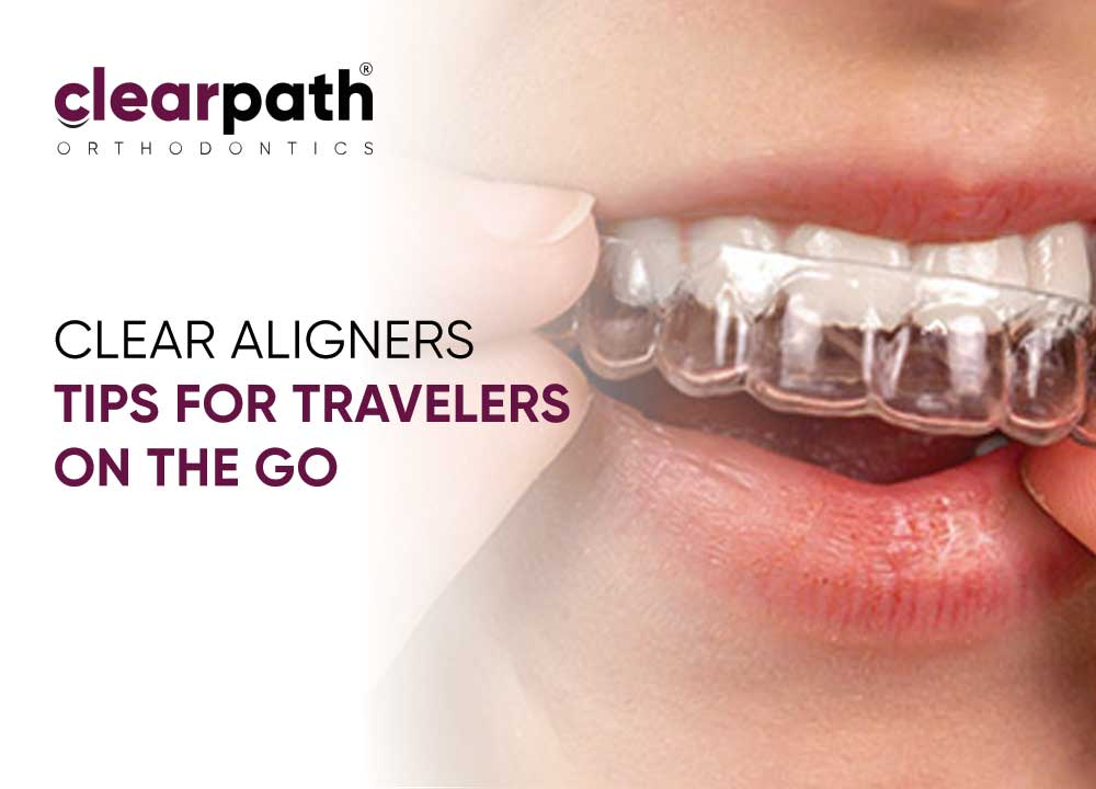 Clear Aligner Travel Hacks