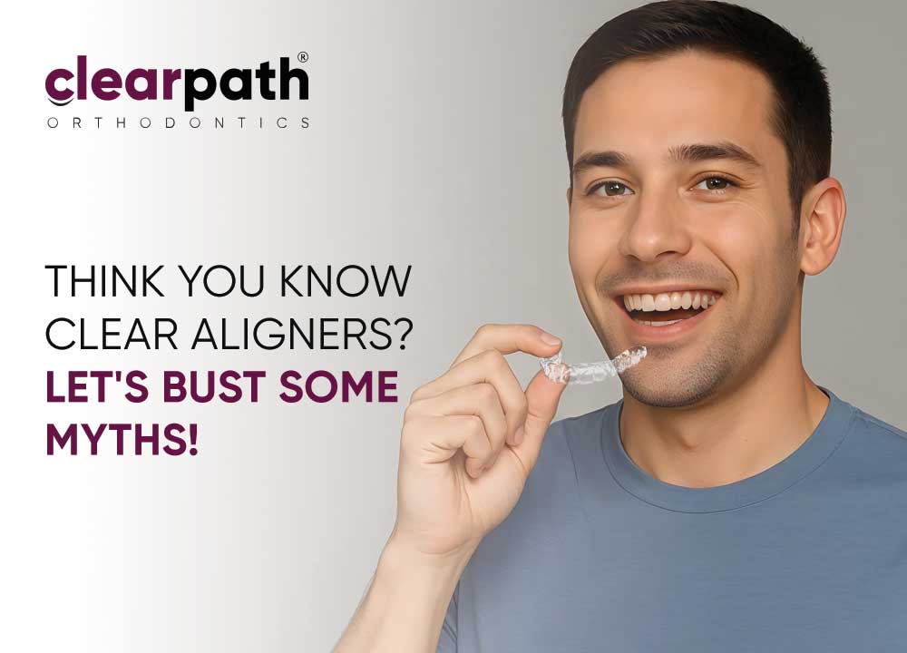Myths About Clear Aligners