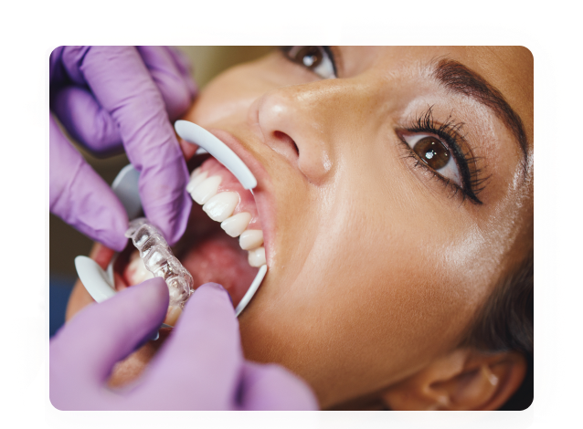 Aligners