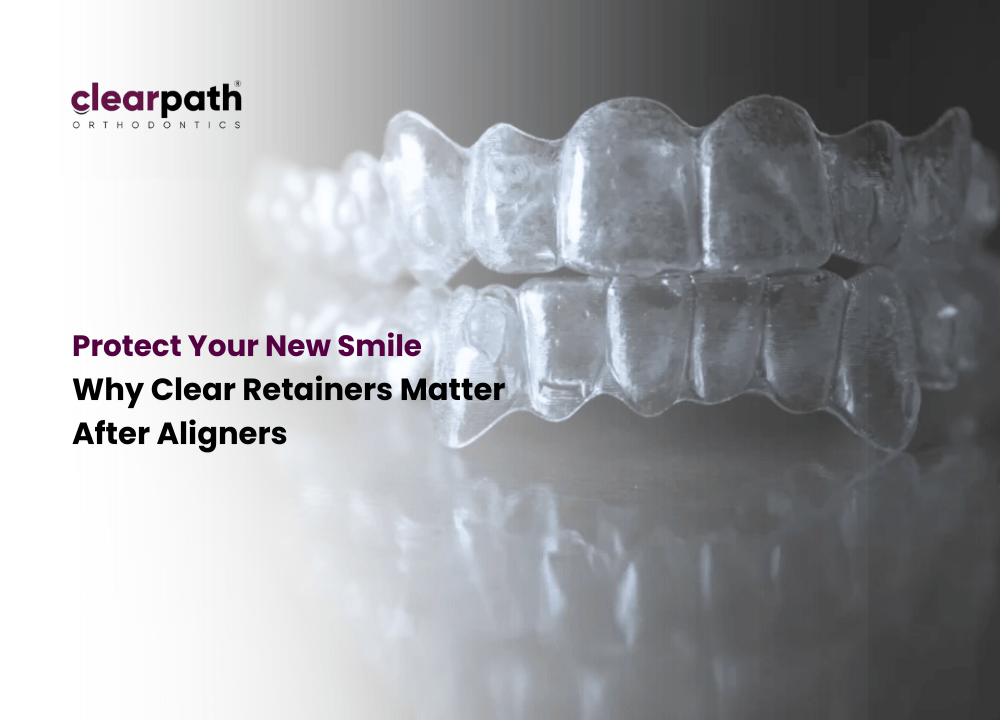 Clear Retyainers Why Clear Retainers Matter After Aligner Treatment