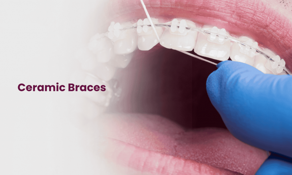 Ceramic Braces