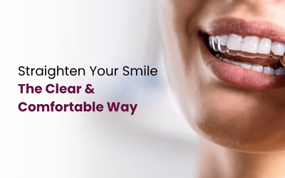 Benefits of Choosing Clear Aligners