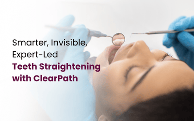 Invisible Aligners for Teeth Straightening