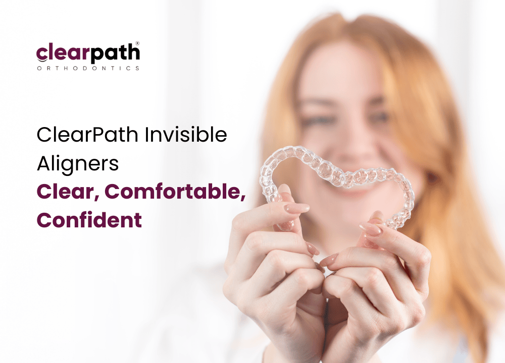 Invisible Aligners