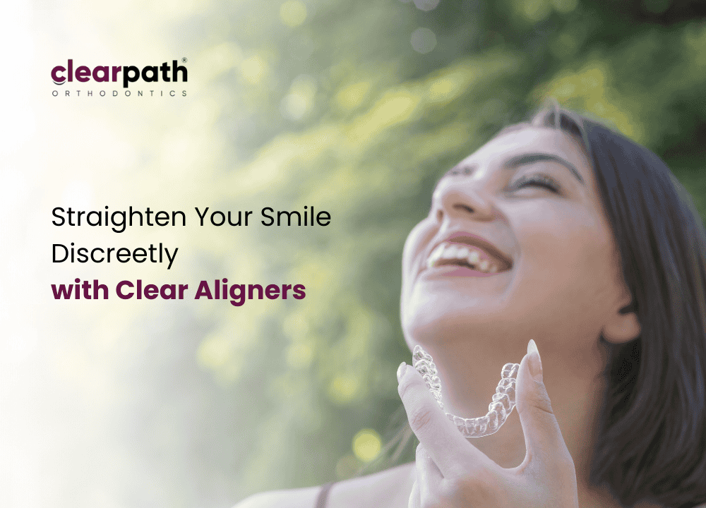 What Are Clear Aligners