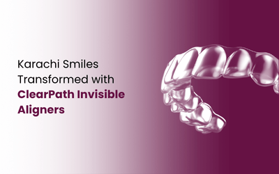 Aligners in Karachi