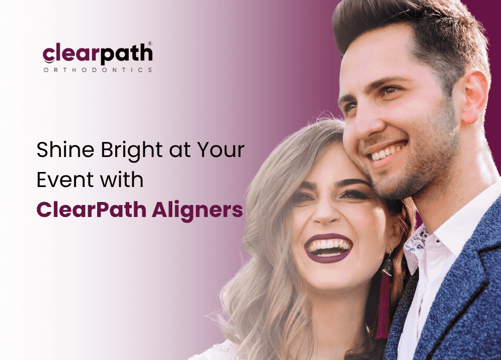 Aligners for Weddings