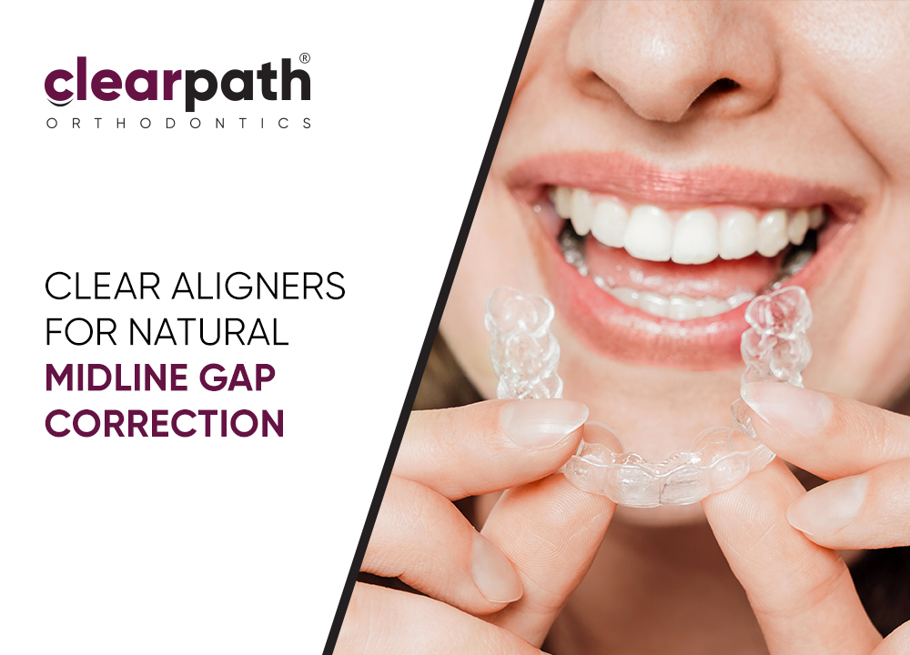 Effective Management of Post Orthodontic Relapse Using ClearPath Aligners
