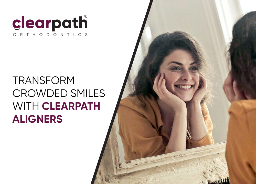 Orthodontic Management of Crowding with ClearPath Aligners