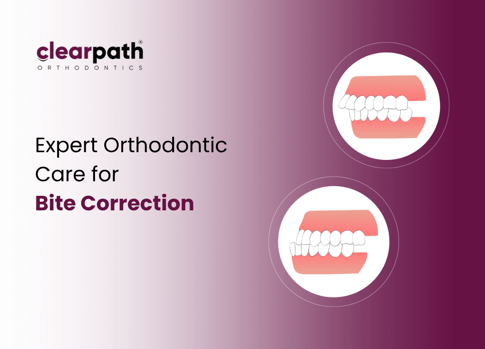 Overbite vs Underbite