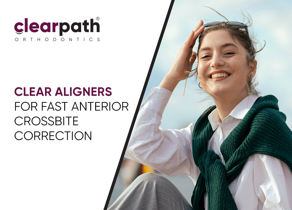 Smile Transformation: Resolving Anterior Crossbite with Clear Aligners