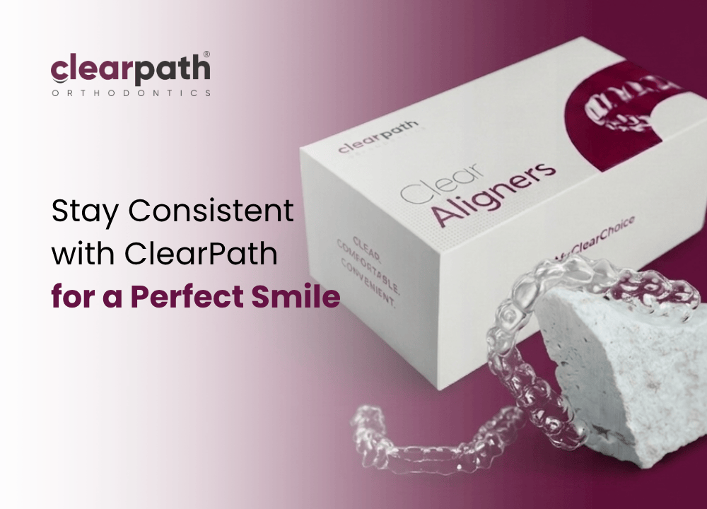 ClearPath aligners